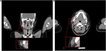 Myxoinflammatory Fibroblastic Sarcoma of the Parotid Gland: First Case Report and Literature Review